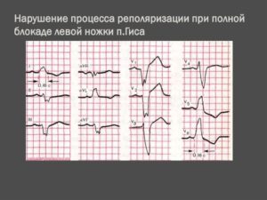 Диффузное нарушение процесса реполяризации и синусовый ритм