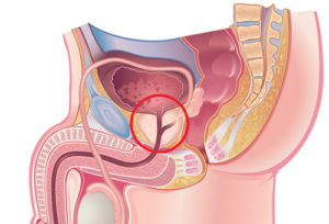 Веностаз простаты