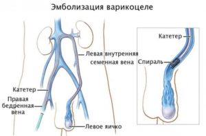 Варикоцеле 1 или 3 группа здоровья