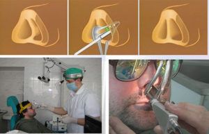 Длительная температура после операции на носовой перегородке