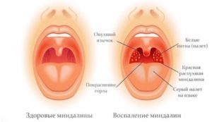 Миндалина разделена на 2 части