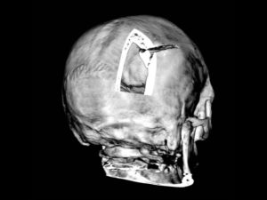 Кости свода черепа, первое узи, патология или нет