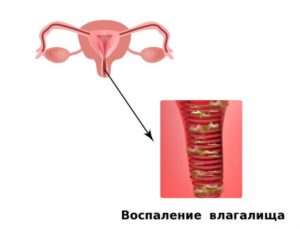 Частые воспаления во влагалище