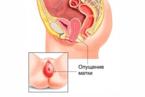 Возможно ли опущение матки при кручении обруча?