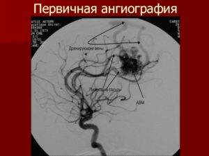 Венозная мальформация у ребенка 3 месяца