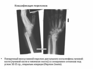 Экстензионный перелом дистального метаэпифиза лучевой кости со смещением