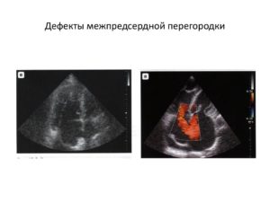 Дефект межпредсердной перегородки у новорожденного