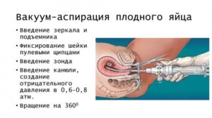 Чистка после фармацевтического аборта