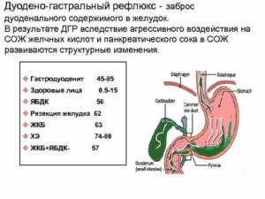 Дуодено-гастральный рефлюкс