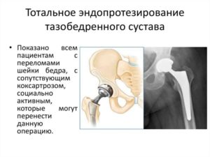 Эндопротезирование тазобедренного сустава инвалидность