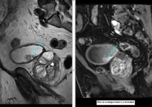 Может ли МРТ не показать опухоль мочевого пузыря