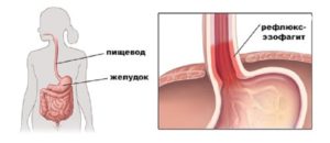 Дистальный катаральный рефлюкс эзофагит и всд