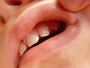 Нарост на десне около зуба