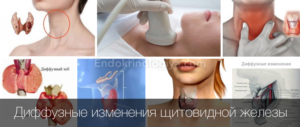 Диффузные изменения щитовидной железы