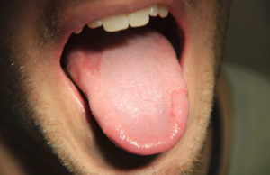 Воспаление и ямка на языке