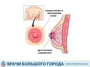 Выделение крови из соска груди при его надавливании