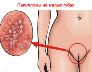 Воспаление влагалища и язвочки на половых губах после ПА