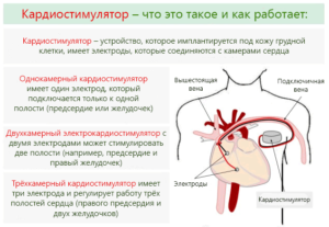 Что делать. Кардиостимулятор остановился