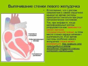 Что значит гиперкинез сердца?
