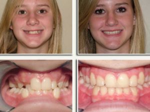Можно ли подтянуть коренные зубы брэкетами?