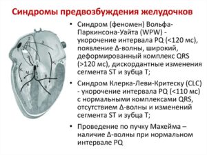 Двухклапанное сердце, clc и wpw феномен у ребенка