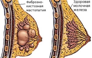 Дифузная фибромо-кистозная мастопатия