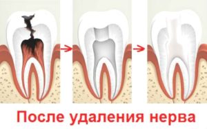 Мышьяк и удаление нерва