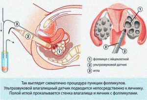 Дюфастон после пункции фолликулов