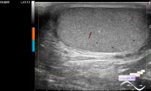Микрокальцинаты и варикоцеле