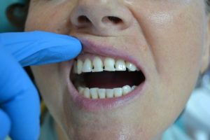 Ужасное состояние зубов, кариес на передних зубах, протезирование нужно