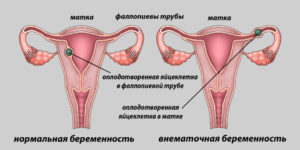 Возможность беременности, если идут месячные