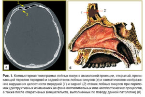 Восстановление после перелома передней стенки лобной пазухи