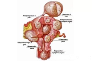 Миома и цистит -есть ли связь?