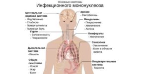 Мононуклеоз ли это?