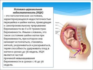 Выделение при ицн