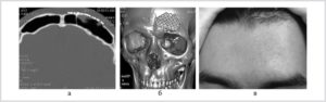 Восстановление после перелома передней стенки лобной пазухи