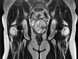 МРТ малого таза