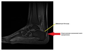 МРТ при ахиллобурсите