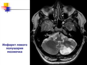 Микрокровоизлияния в левой гемисфере мозжечка