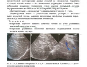 Диффузные изменения в печени и поджелудочной