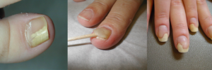 Чем обработать ногтевое ложе после удаления ногтя, был грибок