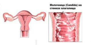 Молочница, воспаление яичников, выделения из груди