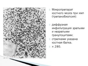 Что такое жировая инфильтрация костного мозга?