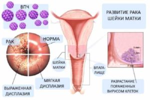 ВПЧ 52 и дисплазия