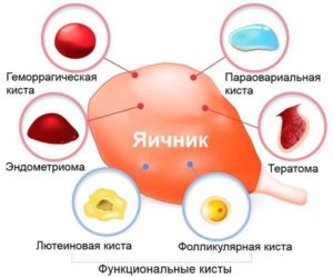 Можно ли заниматься спортом с кистой яичника