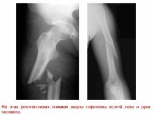На рентген снимке нашли костное образование