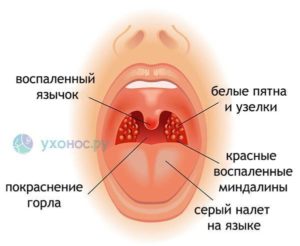 Месяц кашель, бактерии и белый налет в горле