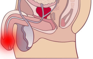 Воспалился половой член, опух