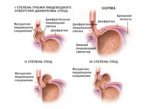 Чем лечить ГЭРБ 1 степени и ГПОД 1 степени