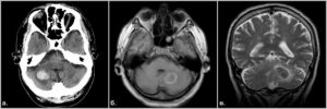 Микрокровоизлияния в левой гемисфере мозжечка